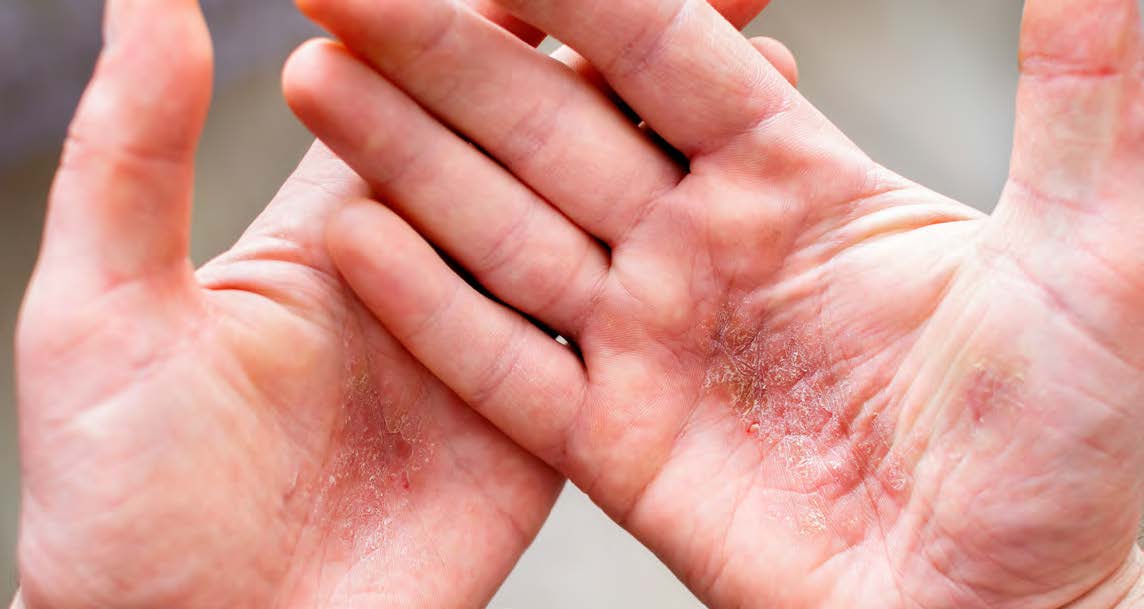Von Psoriasis betroffene Handflächen